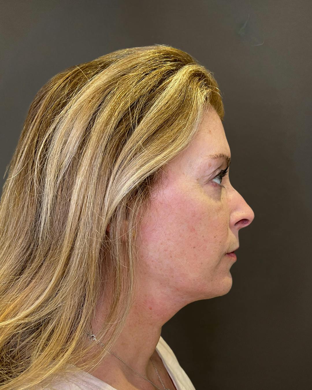 Facelifts / Necklift Before & After Gallery - Patient 830010 - Image 4