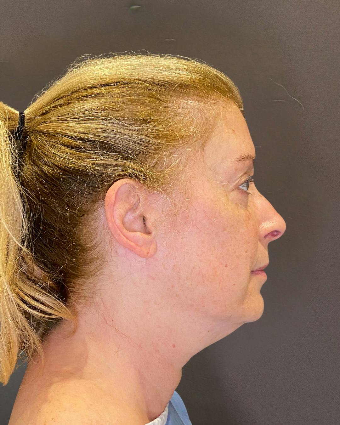 Facelifts / Necklift Before & After Gallery - Patient 830010 - Image 3
