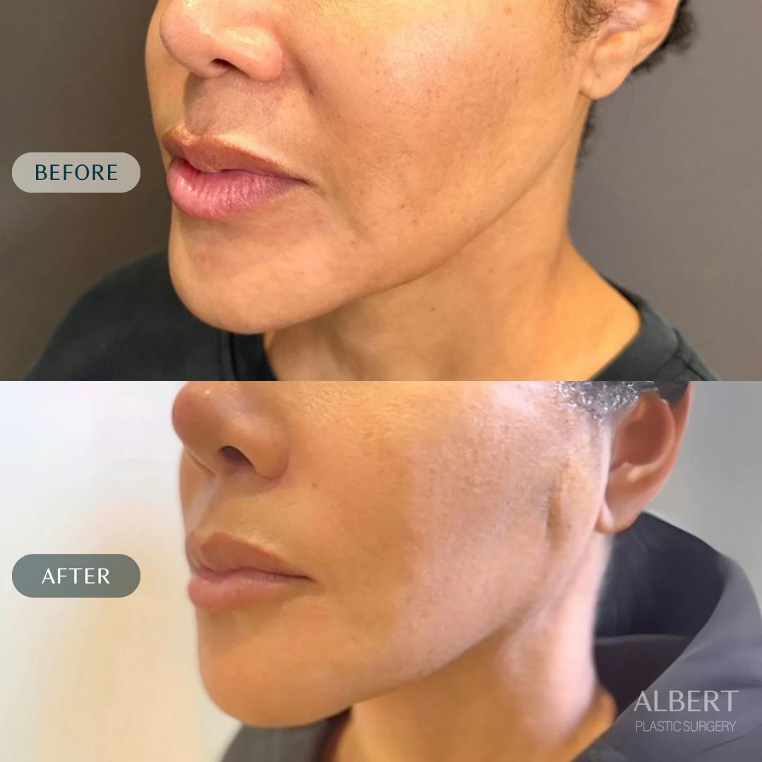 Nanolift Before & After Gallery - Patient 142439 - Image 2