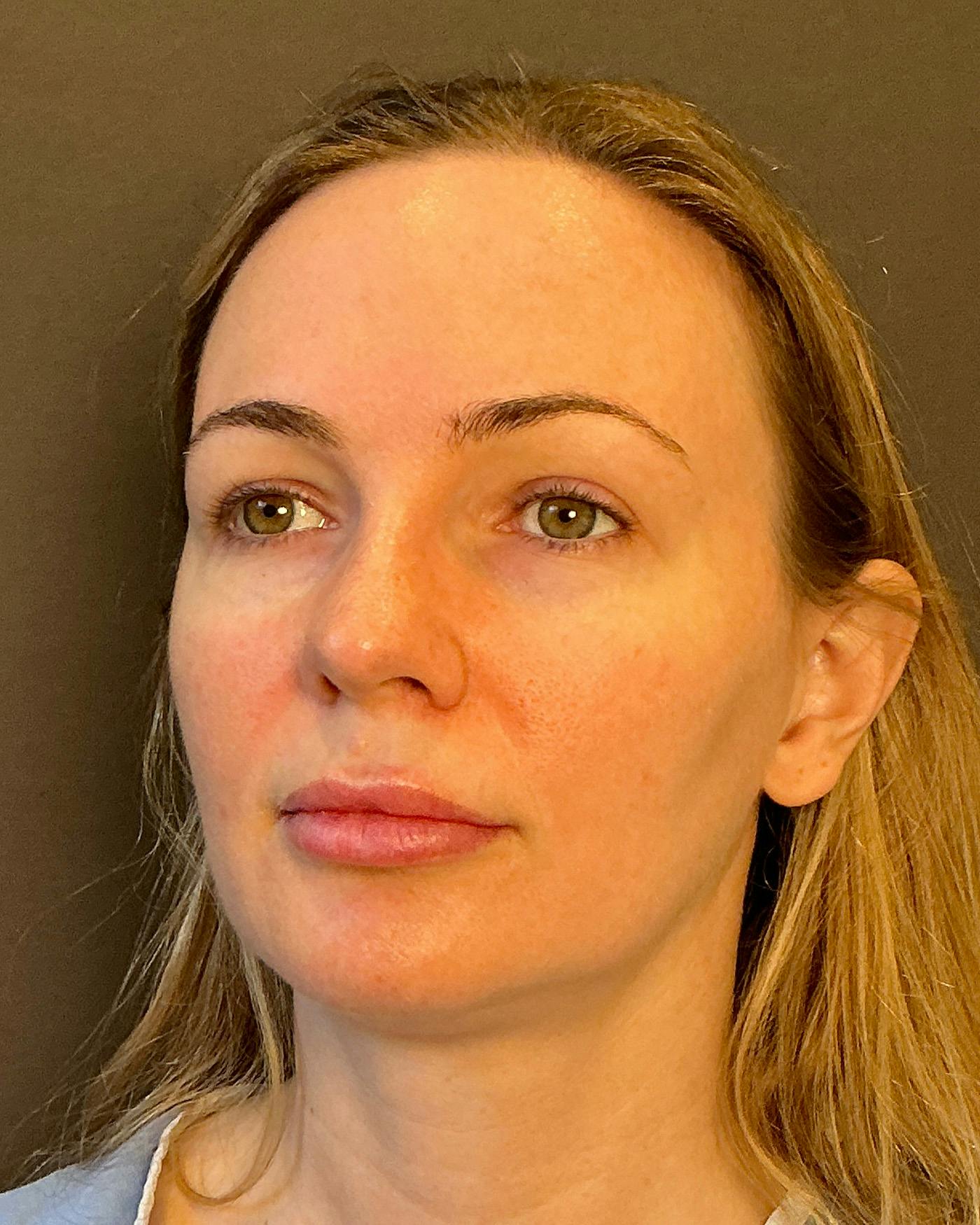 Nanolift Before & After Gallery - Patient 215709 - Image 7