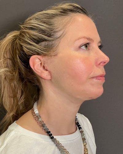 Facelifts / Necklift Before & After Gallery - Patient 423844 - Image 2