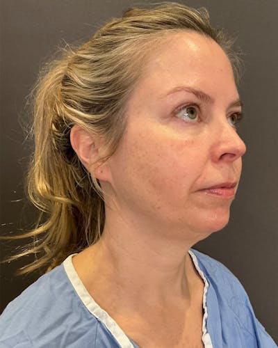 Facelifts / Necklift Before & After Gallery - Patient 423844 - Image 1