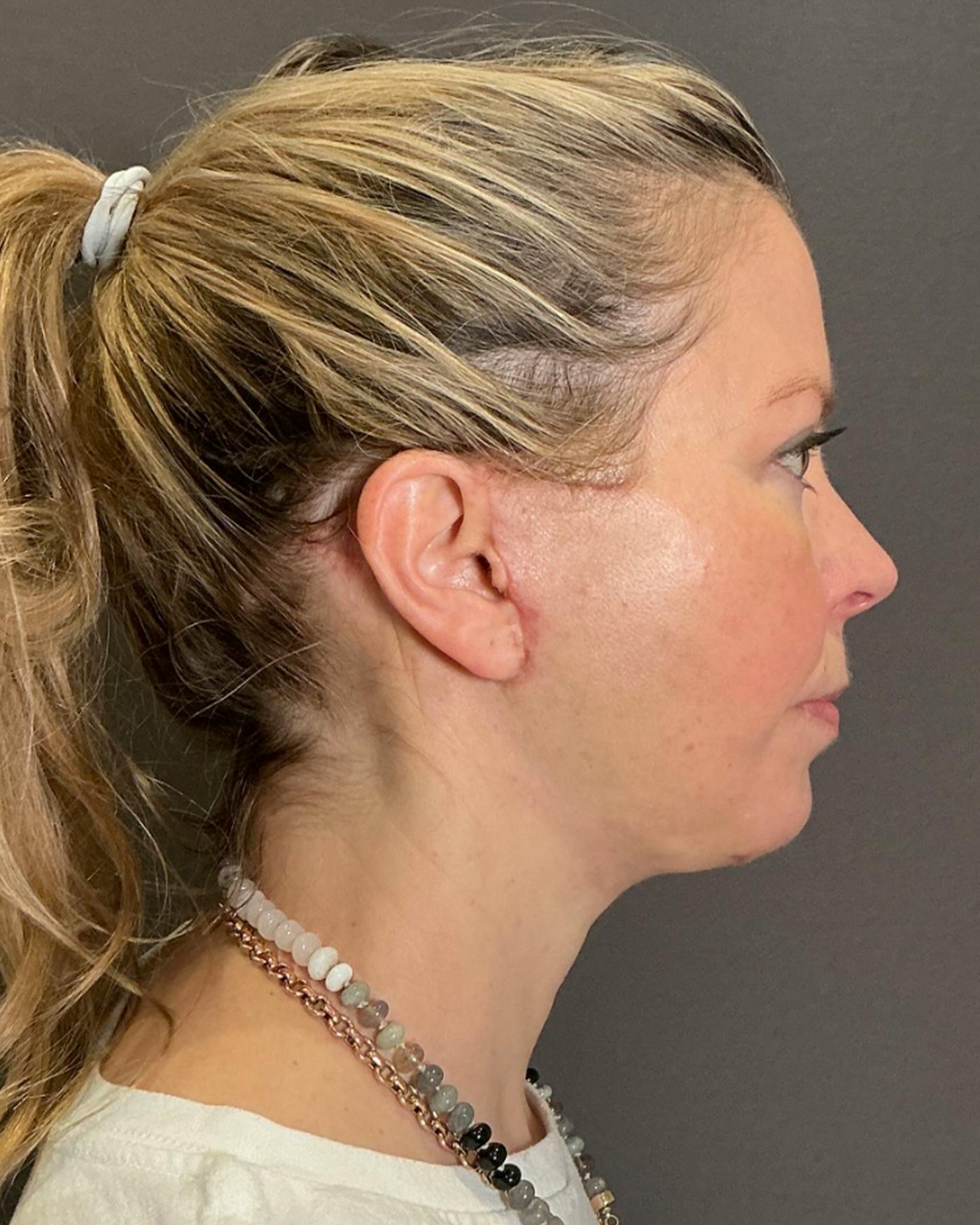Facelifts / Necklift Before & After Gallery - Patient 423844 - Image 4