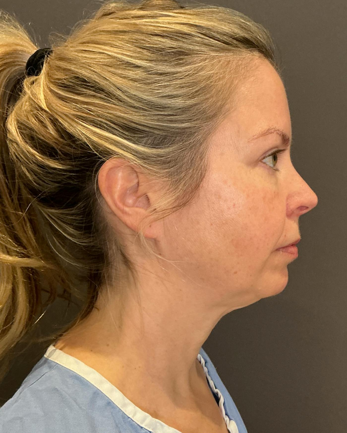 Facelifts / Necklift Before & After Gallery - Patient 423844 - Image 3