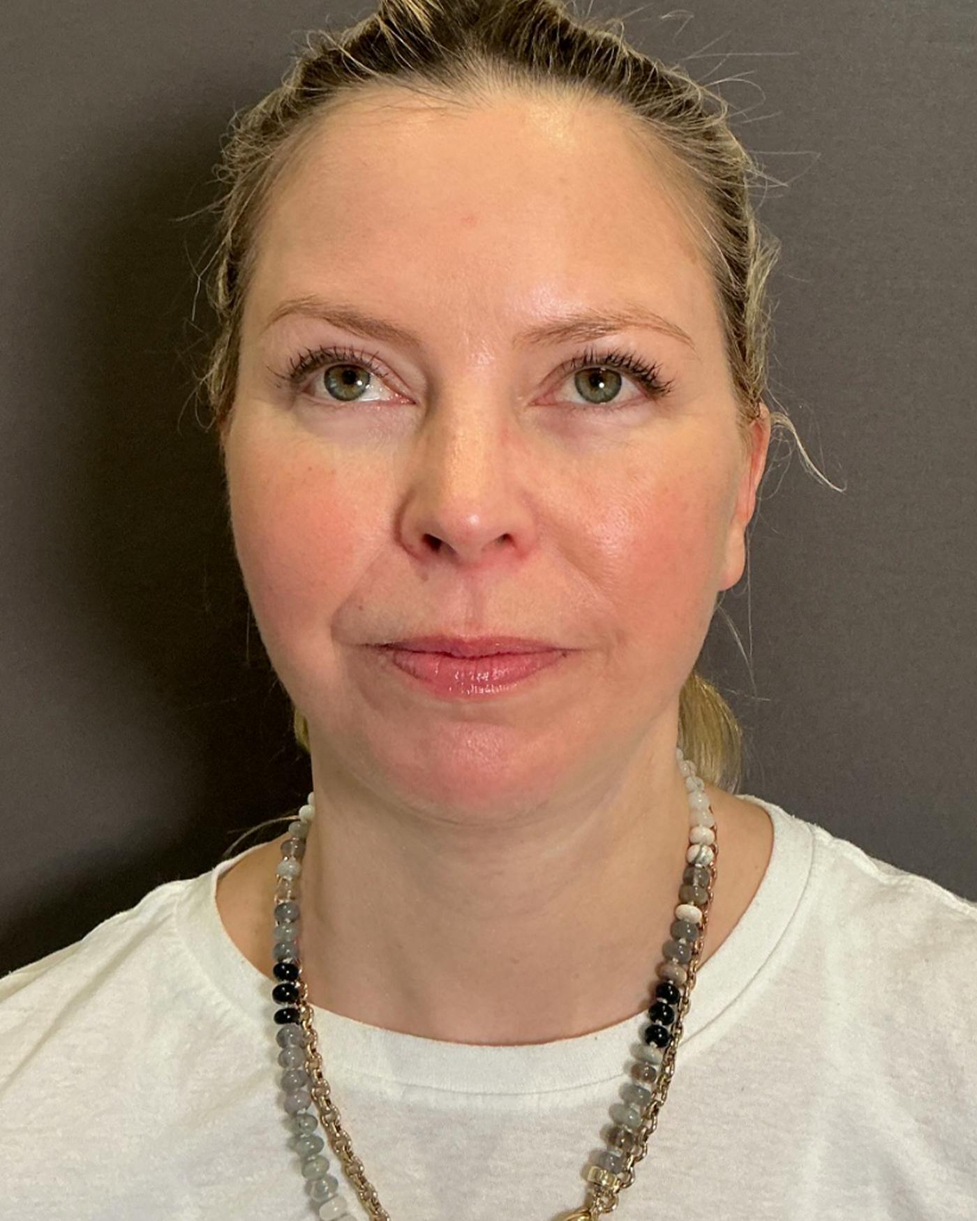 Facelifts / Necklift Before & After Gallery - Patient 423844 - Image 6