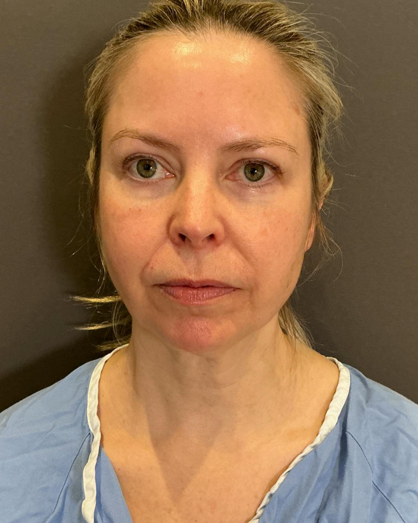 Facelifts / Necklift Before & After Gallery - Patient 423844 - Image 5