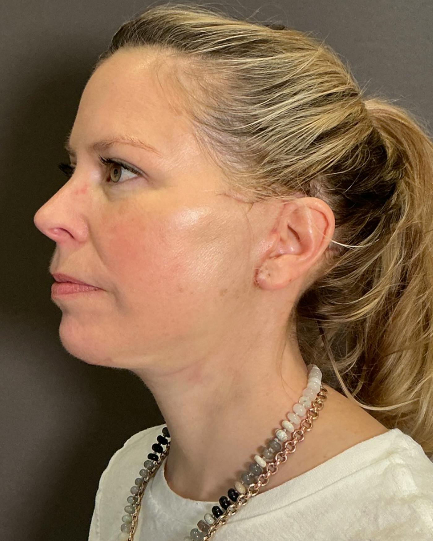 Facelifts / Necklift Before & After Gallery - Patient 423844 - Image 8