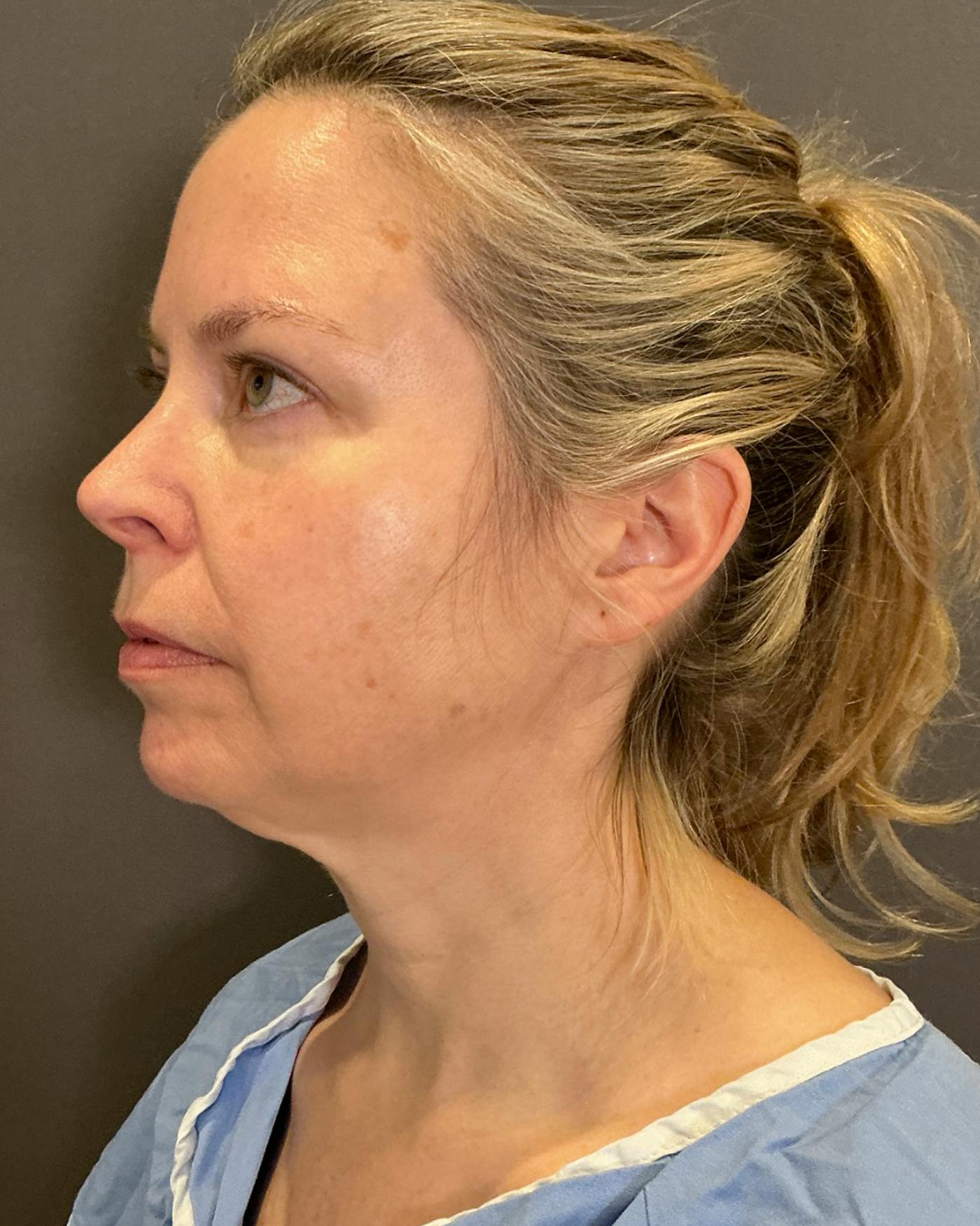 Facelifts / Necklift Before & After Gallery - Patient 423844 - Image 7