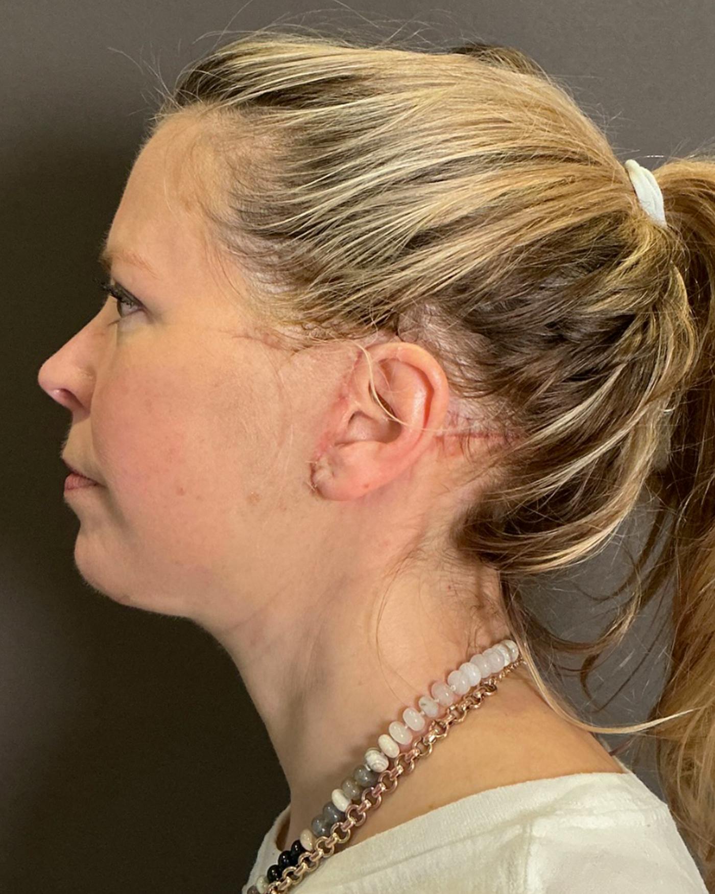 Facelifts / Necklift Before & After Gallery - Patient 423844 - Image 10