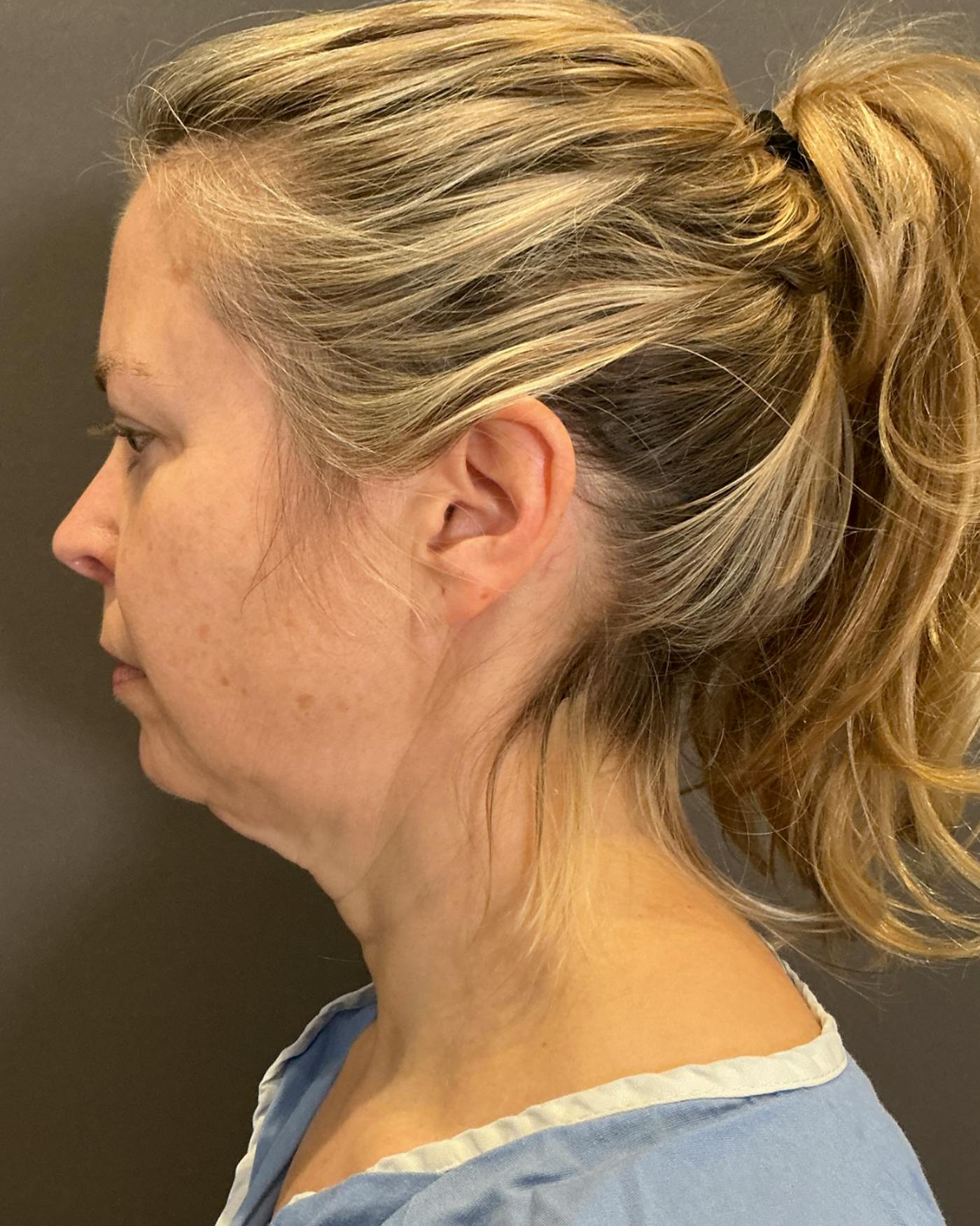 Facelifts / Necklift Before & After Gallery - Patient 423844 - Image 9