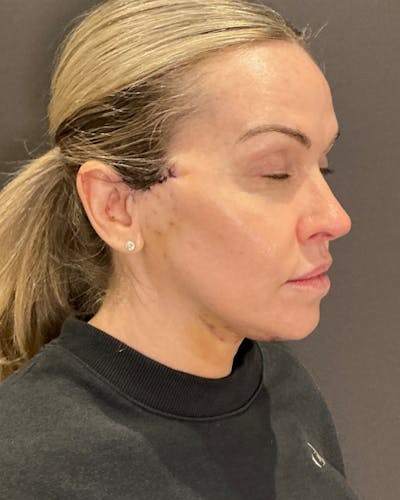 Nanolift Before & After Gallery - Patient 428237 - Image 2