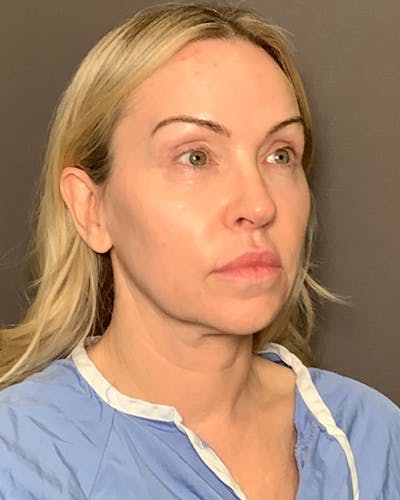 Nanolift Before & After Gallery - Patient 428237 - Image 1