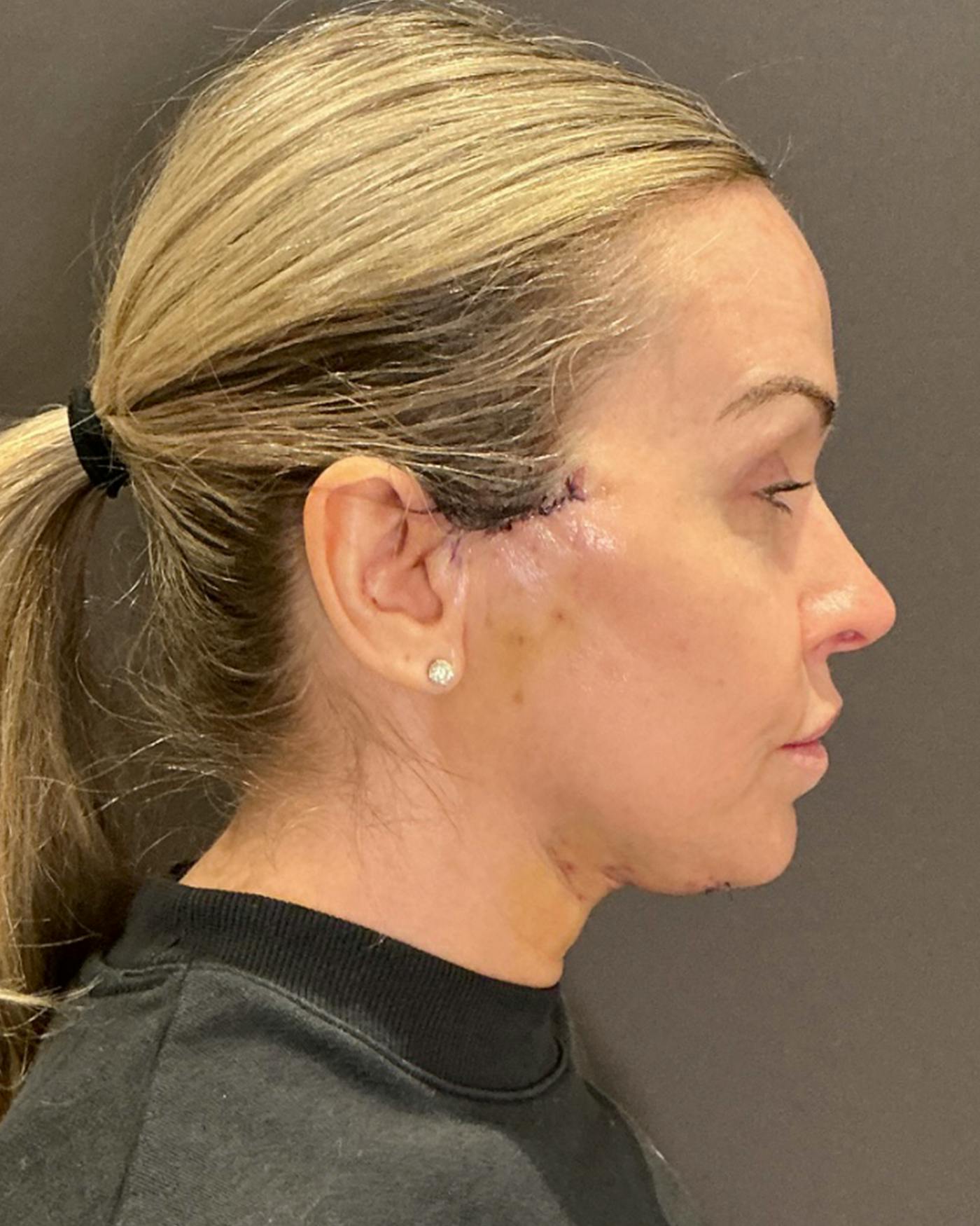 Facelifts / Necklift Before & After Gallery - Patient 674796 - Image 4