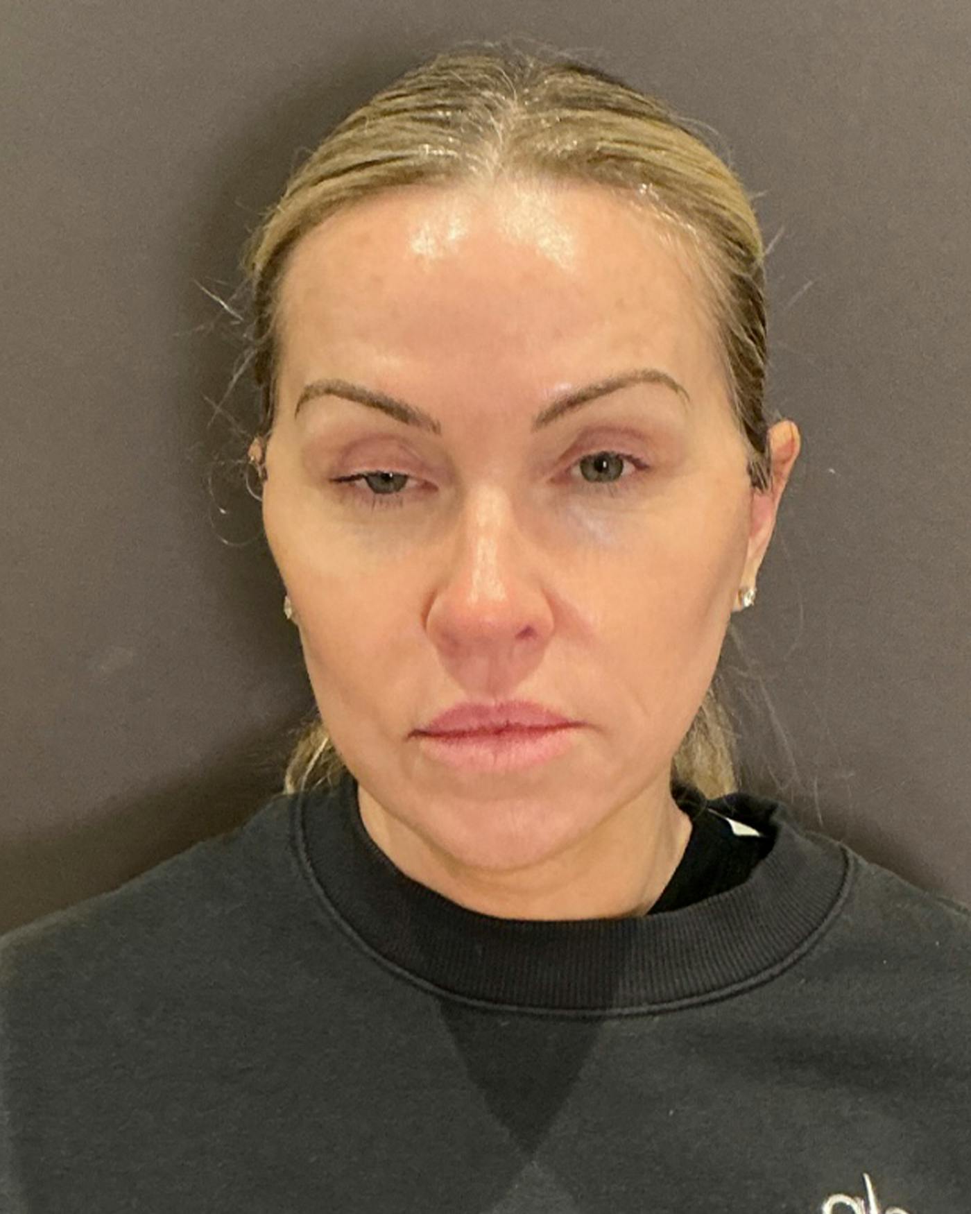 Facelifts / Necklift Before & After Gallery - Patient 674796 - Image 6