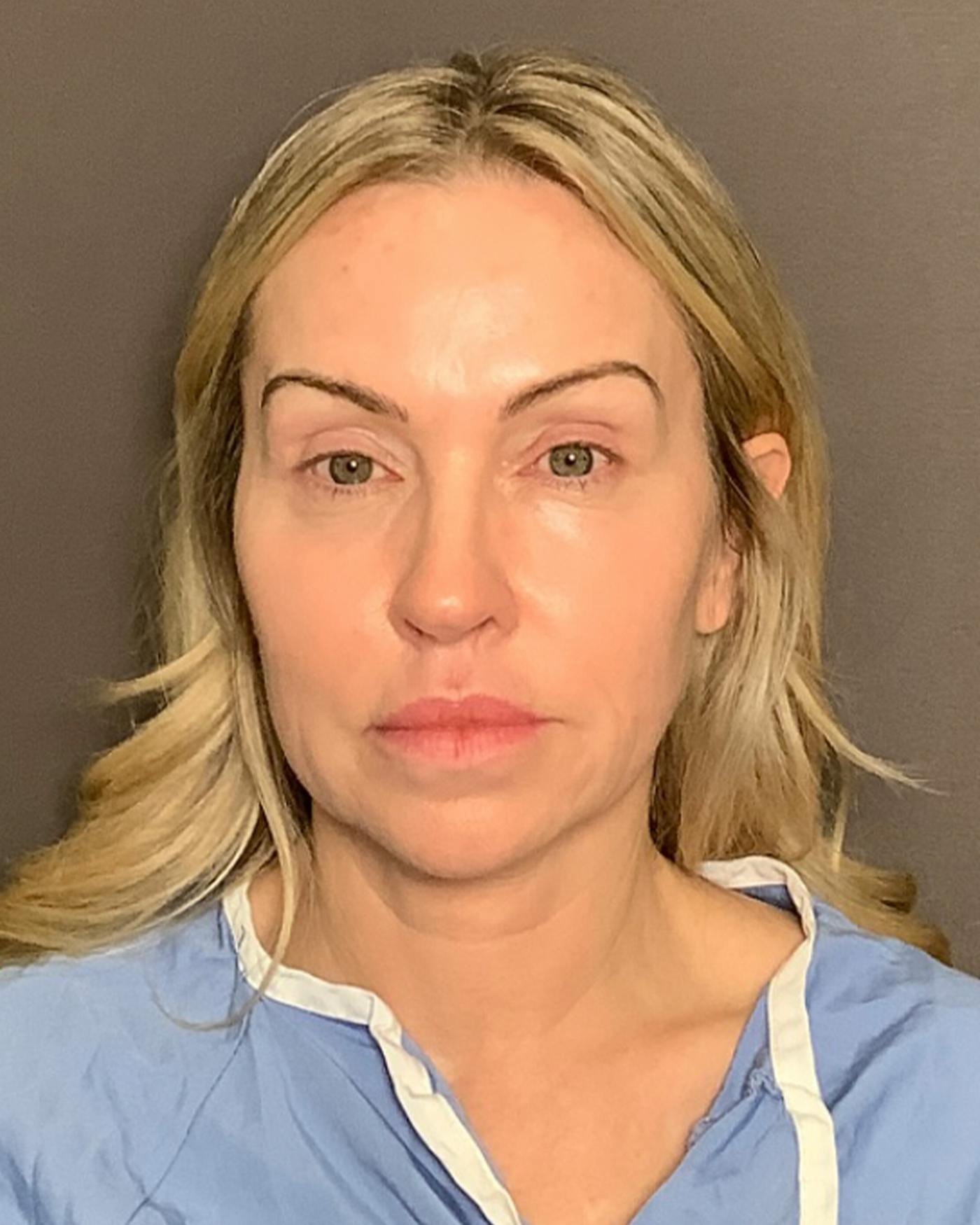 Facelifts / Necklift Before & After Gallery - Patient 674796 - Image 5