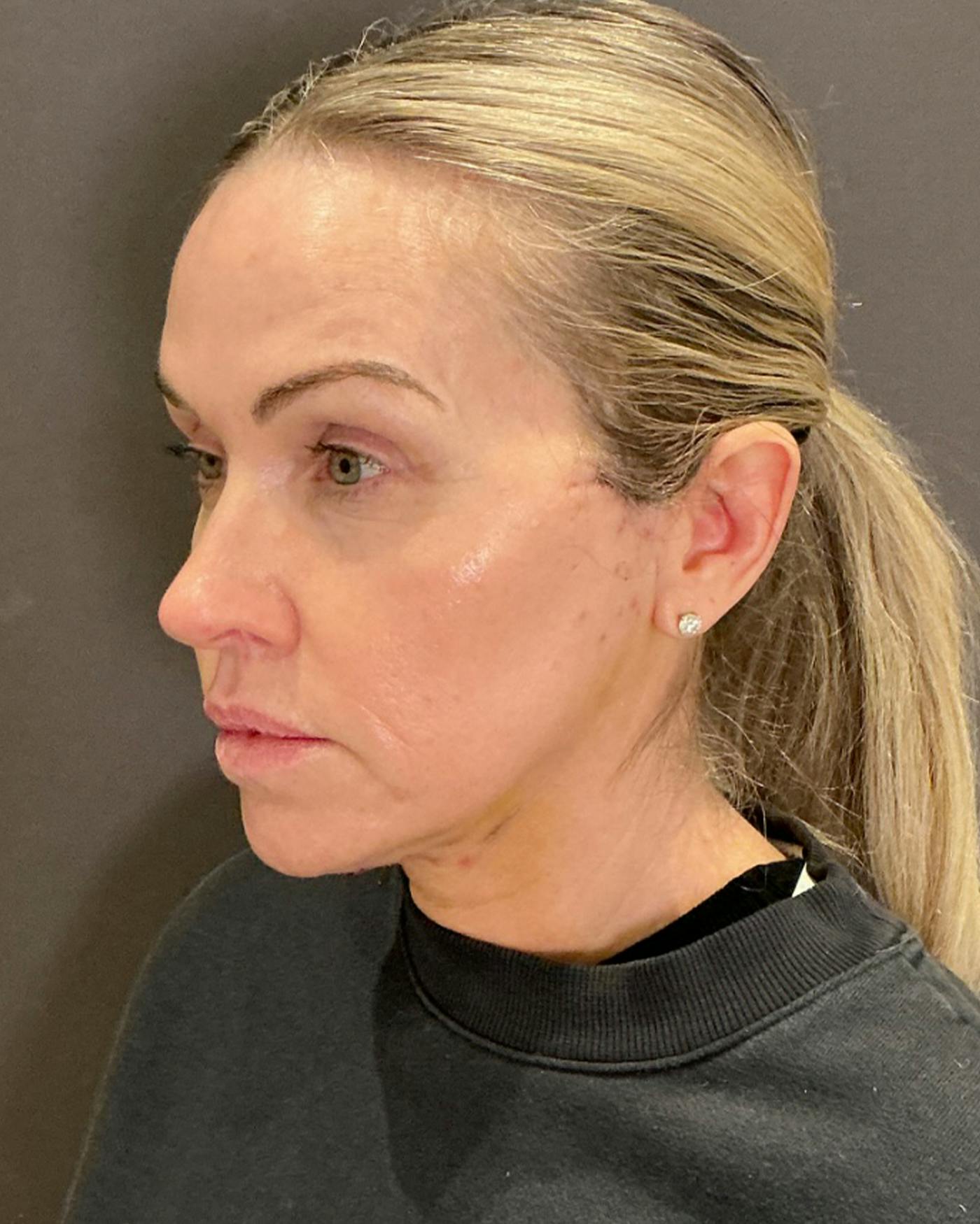 Facelifts / Necklift Before & After Gallery - Patient 674796 - Image 8