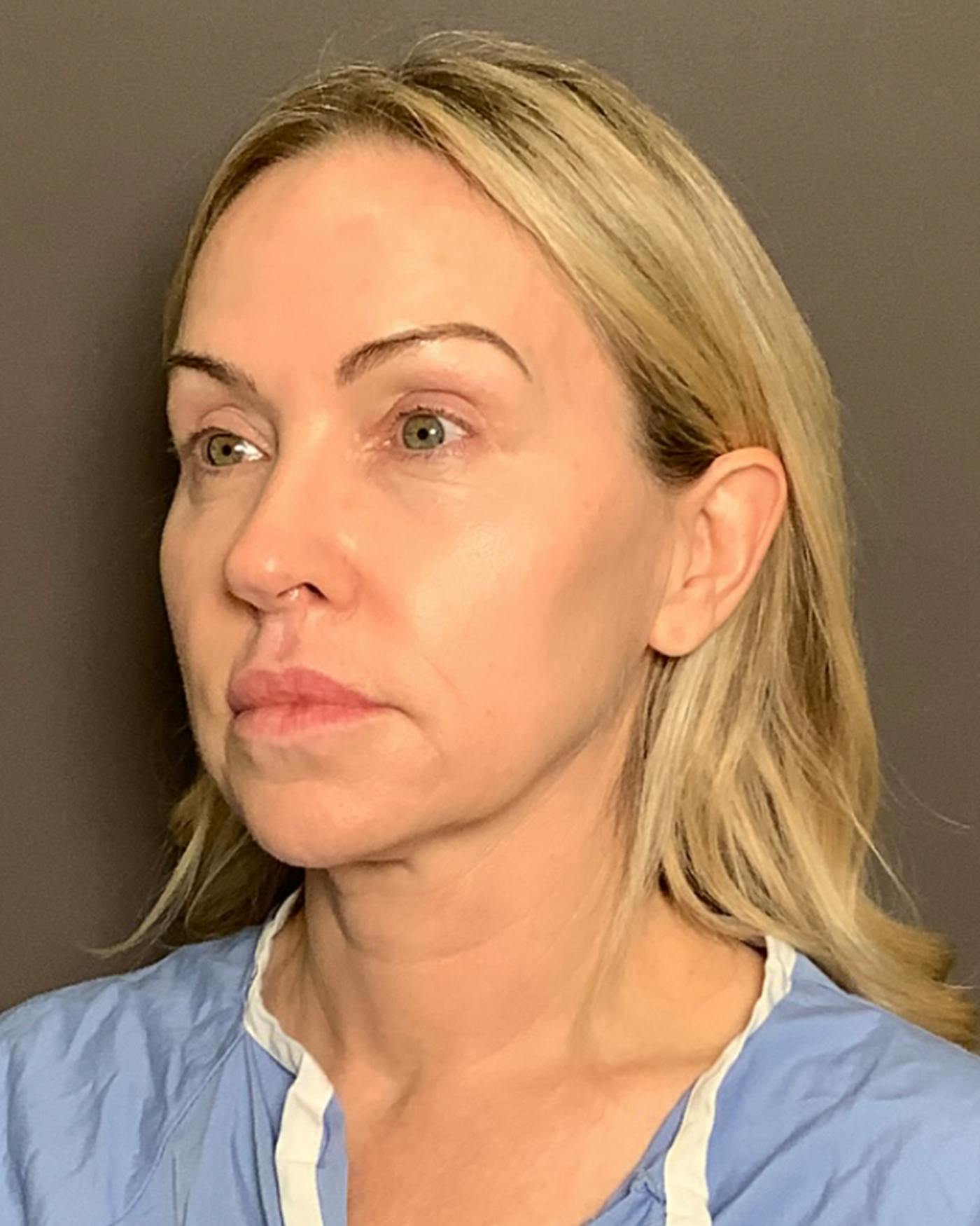 Facelifts / Necklift Before & After Gallery - Patient 674796 - Image 7