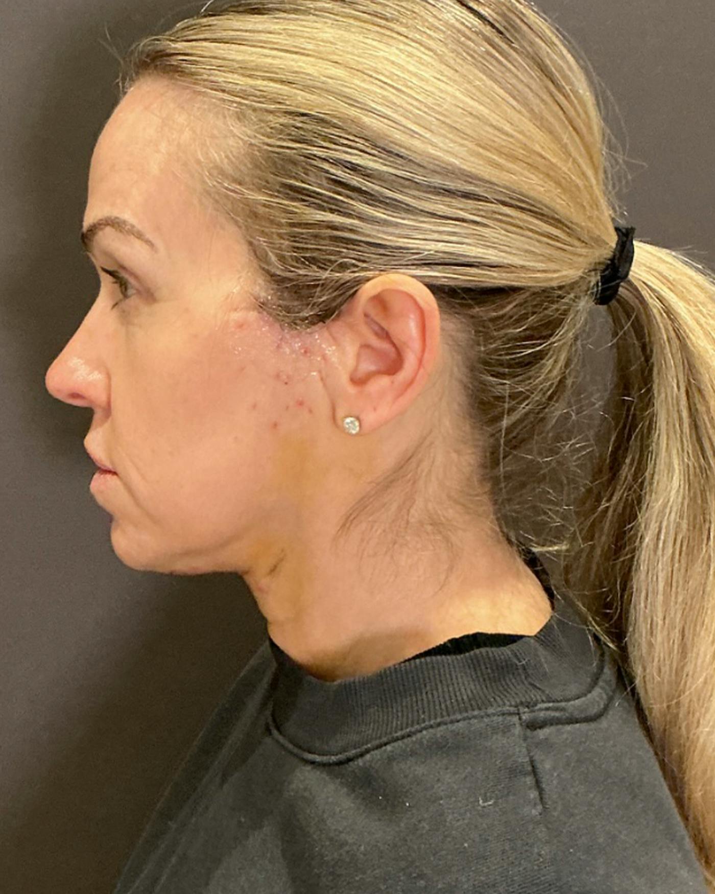 Facelifts / Necklift Before & After Gallery - Patient 674796 - Image 10