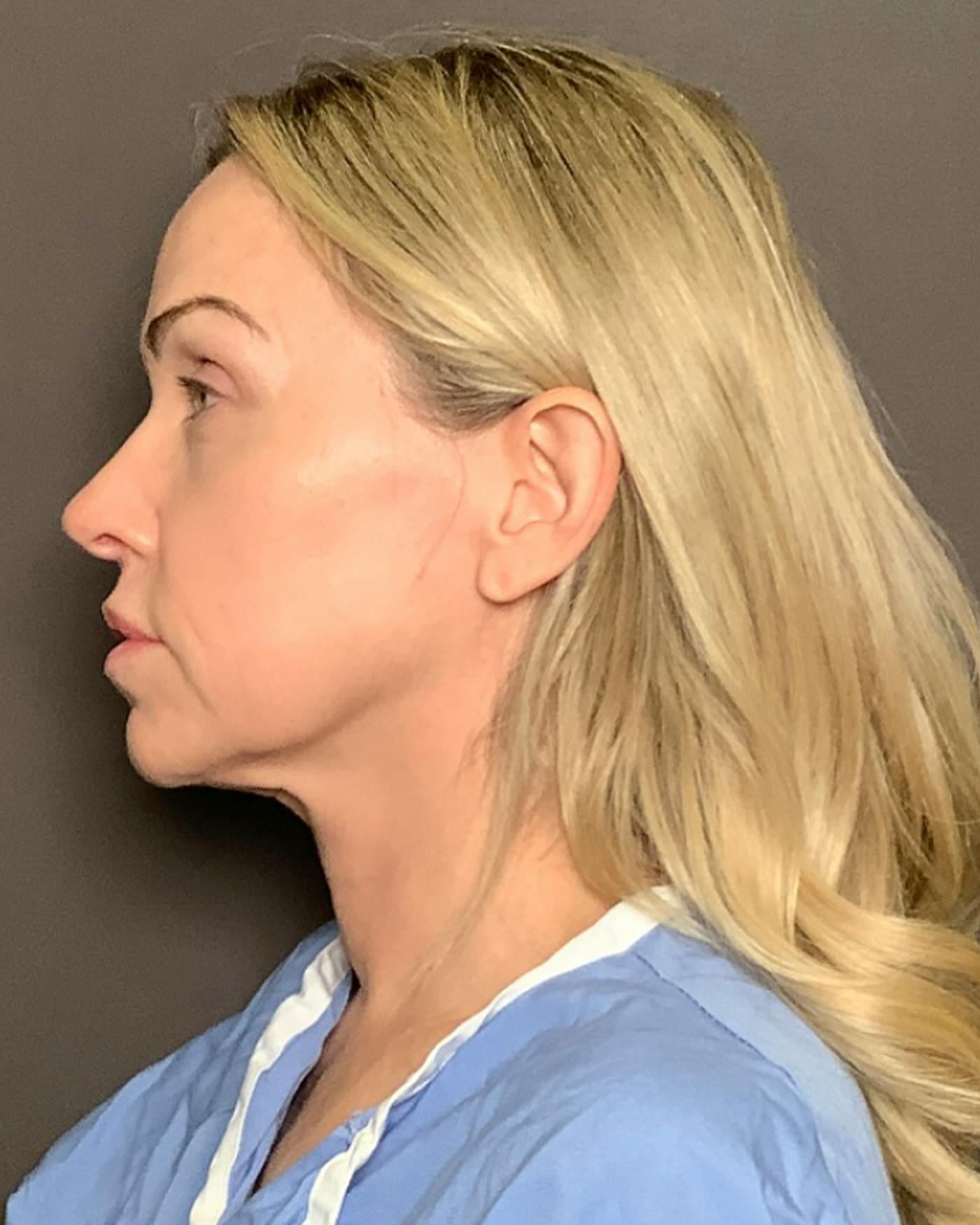 Facelifts / Necklift Before & After Gallery - Patient 674796 - Image 9