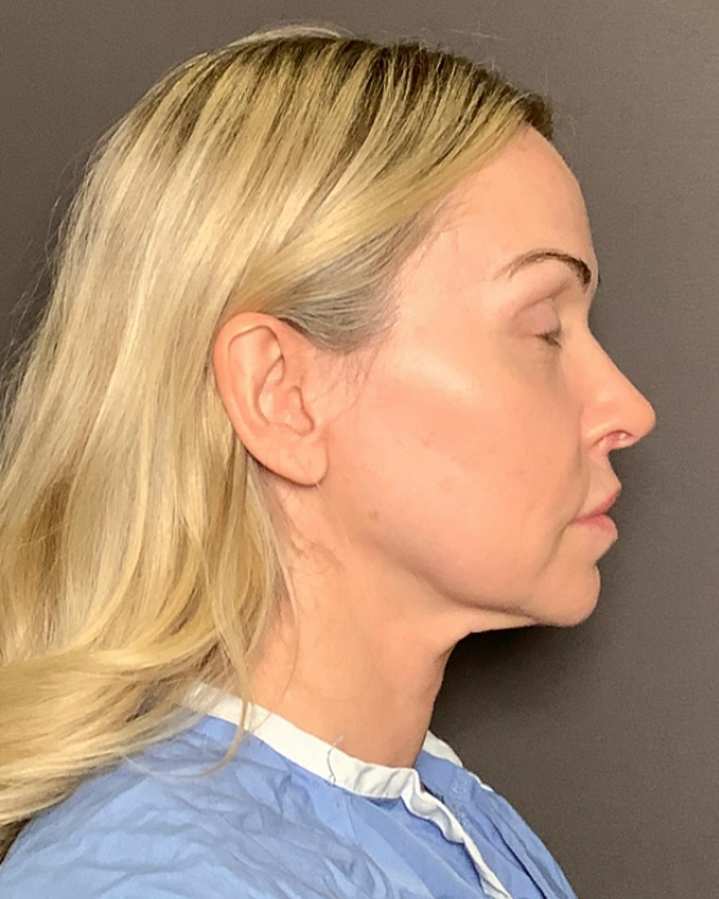 Facelifts / Necklift Before & After Gallery - Patient 674796 - Image 3
