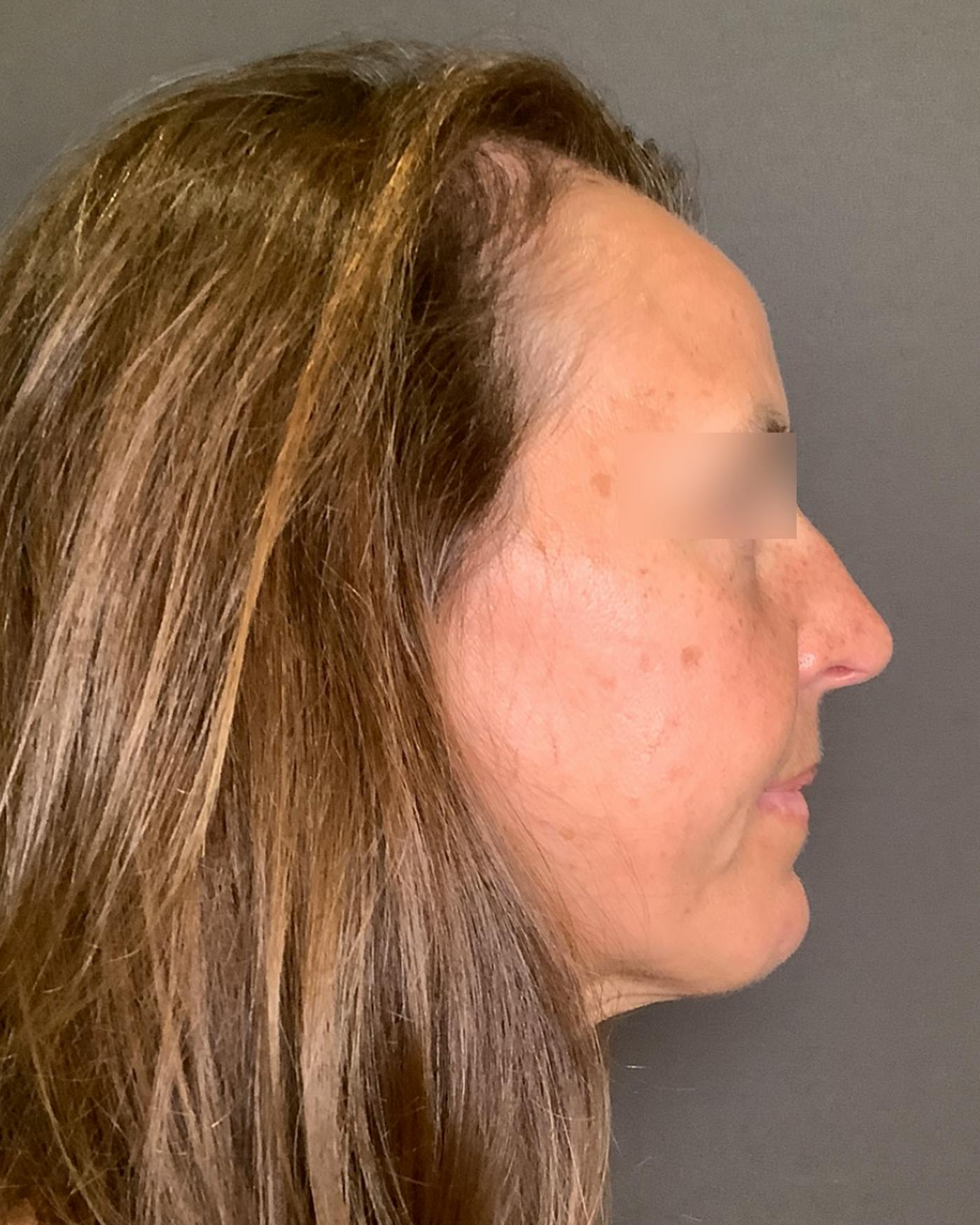 Brow Lift Before & After Gallery - Patient 120517 - Image 3