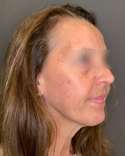 Facelifts / Necklift Before & After Gallery - Patient 351760 - Image 1