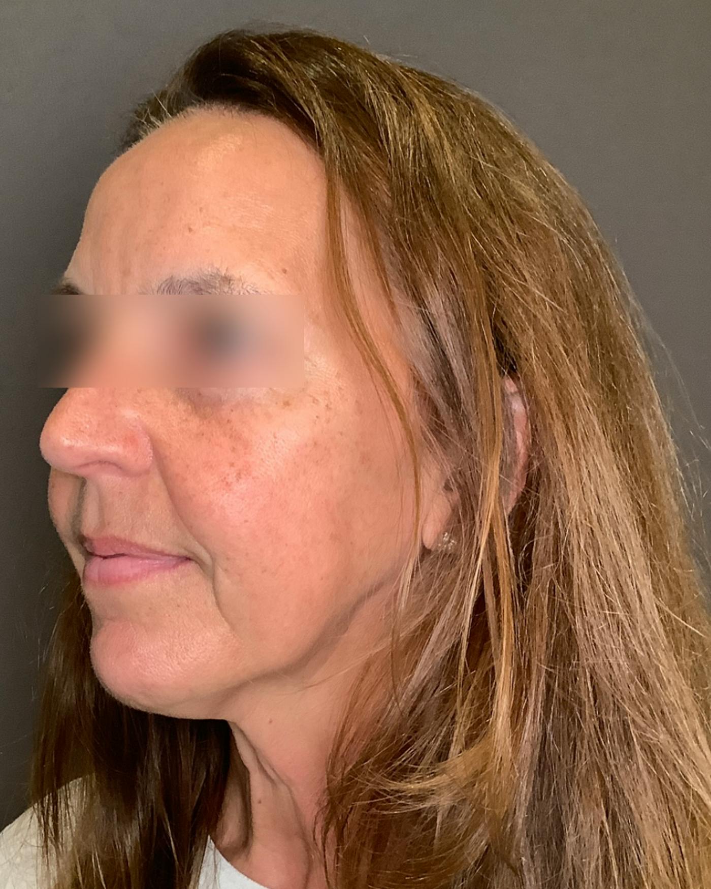 Brow Lift Before & After Gallery - Patient 120517 - Image 5