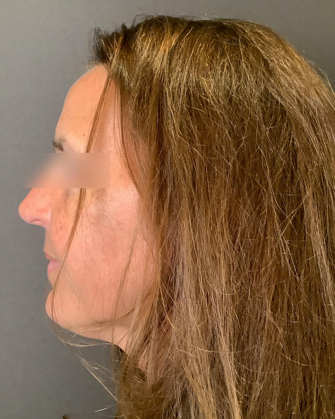 Brow Lift Before & After Gallery - Patient 120517 - Image 7