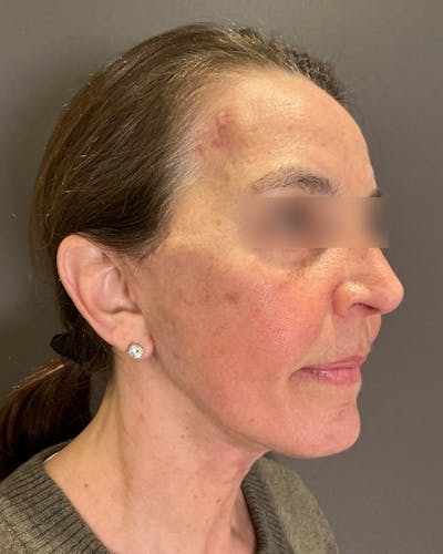 Facelifts / Necklift Before & After Gallery - Patient 351760 - Image 2