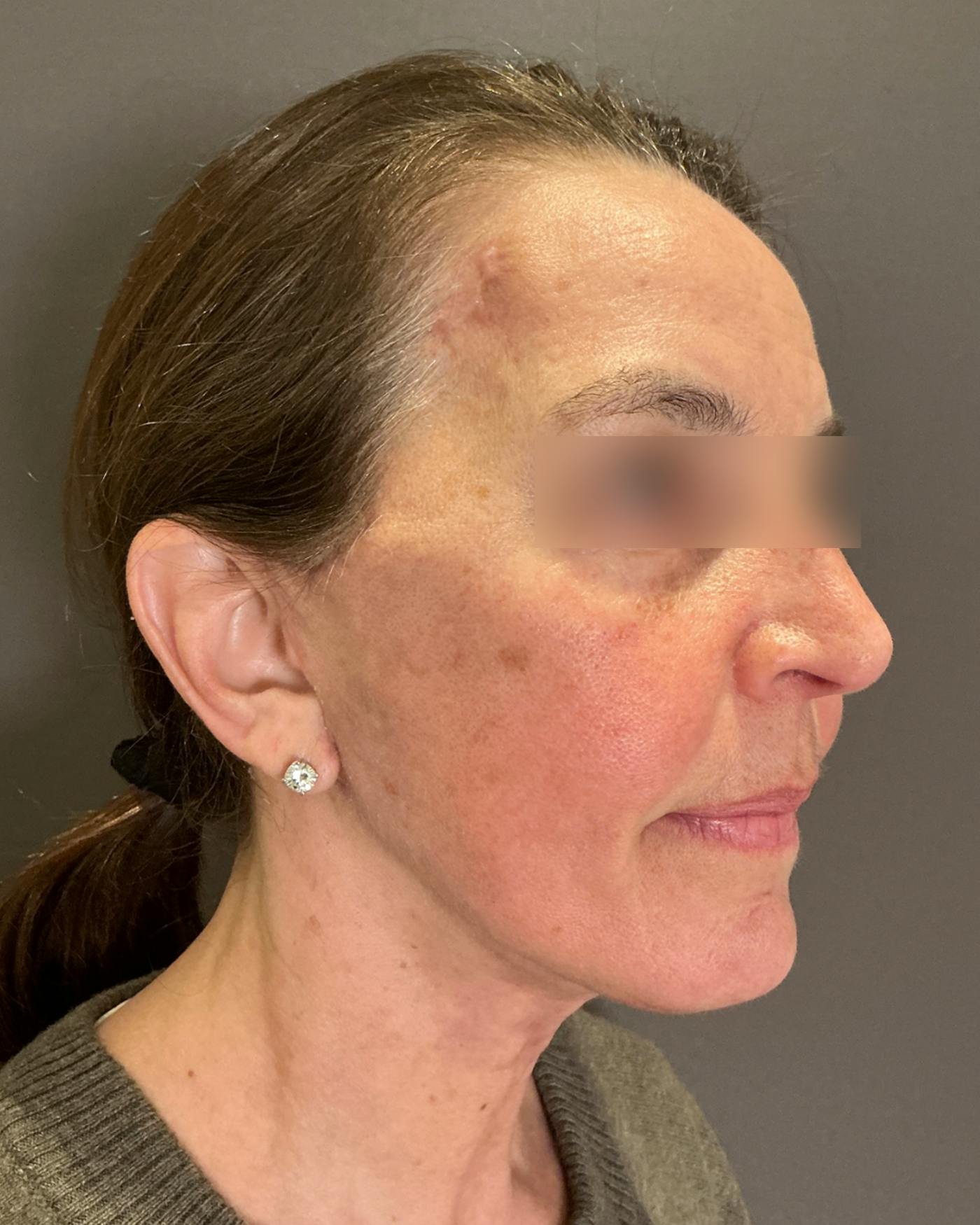 Brow Lift Before & After Gallery - Patient 120517 - Image 2