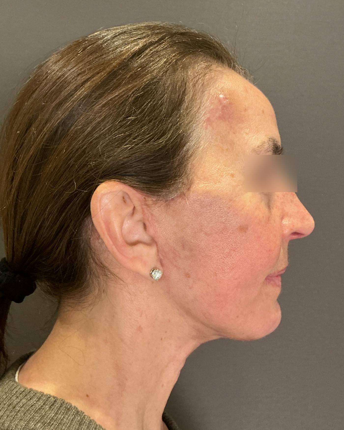 Brow Lift Before & After Gallery - Patient 120517 - Image 4