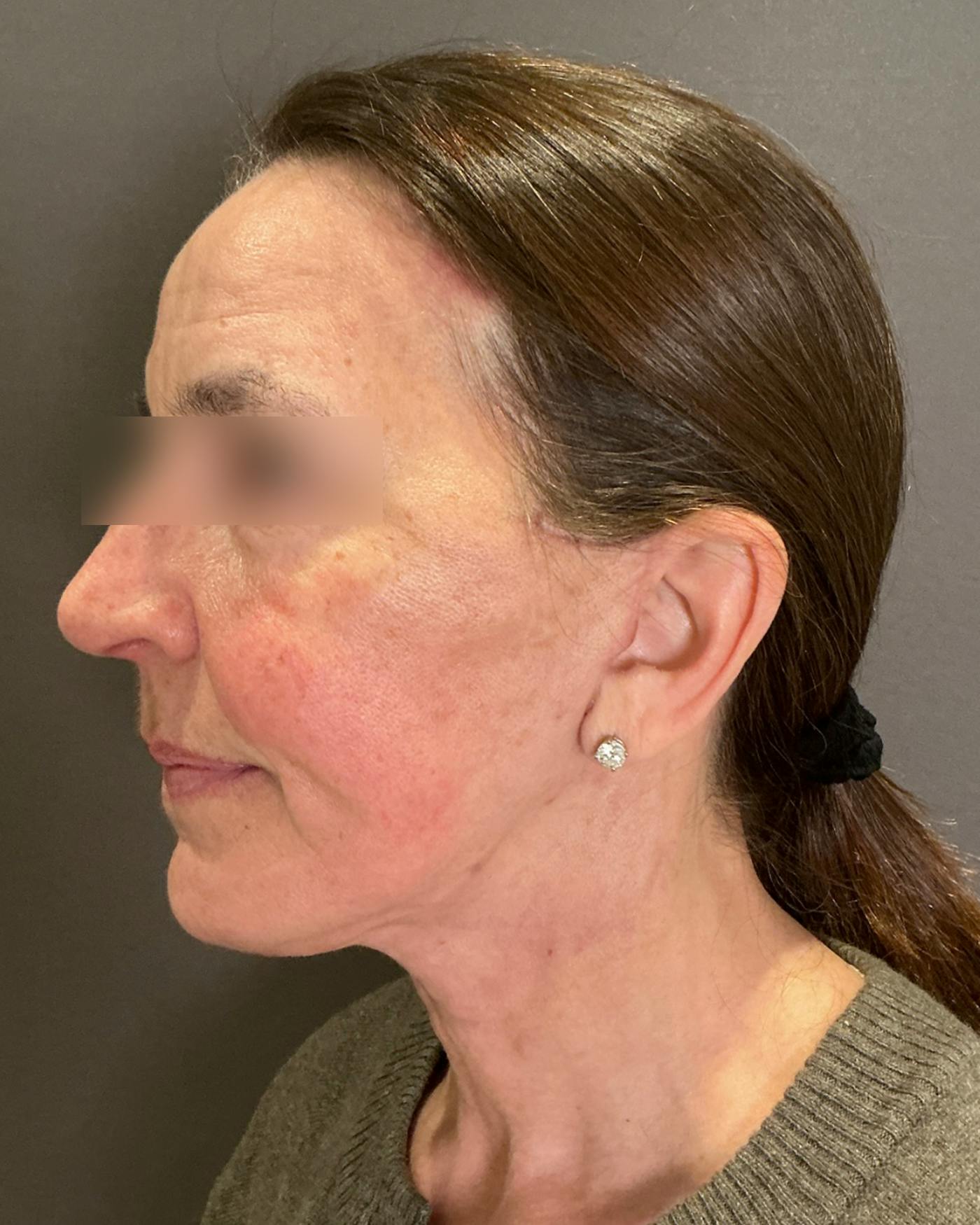 Brow Lift Before & After Gallery - Patient 120517 - Image 6