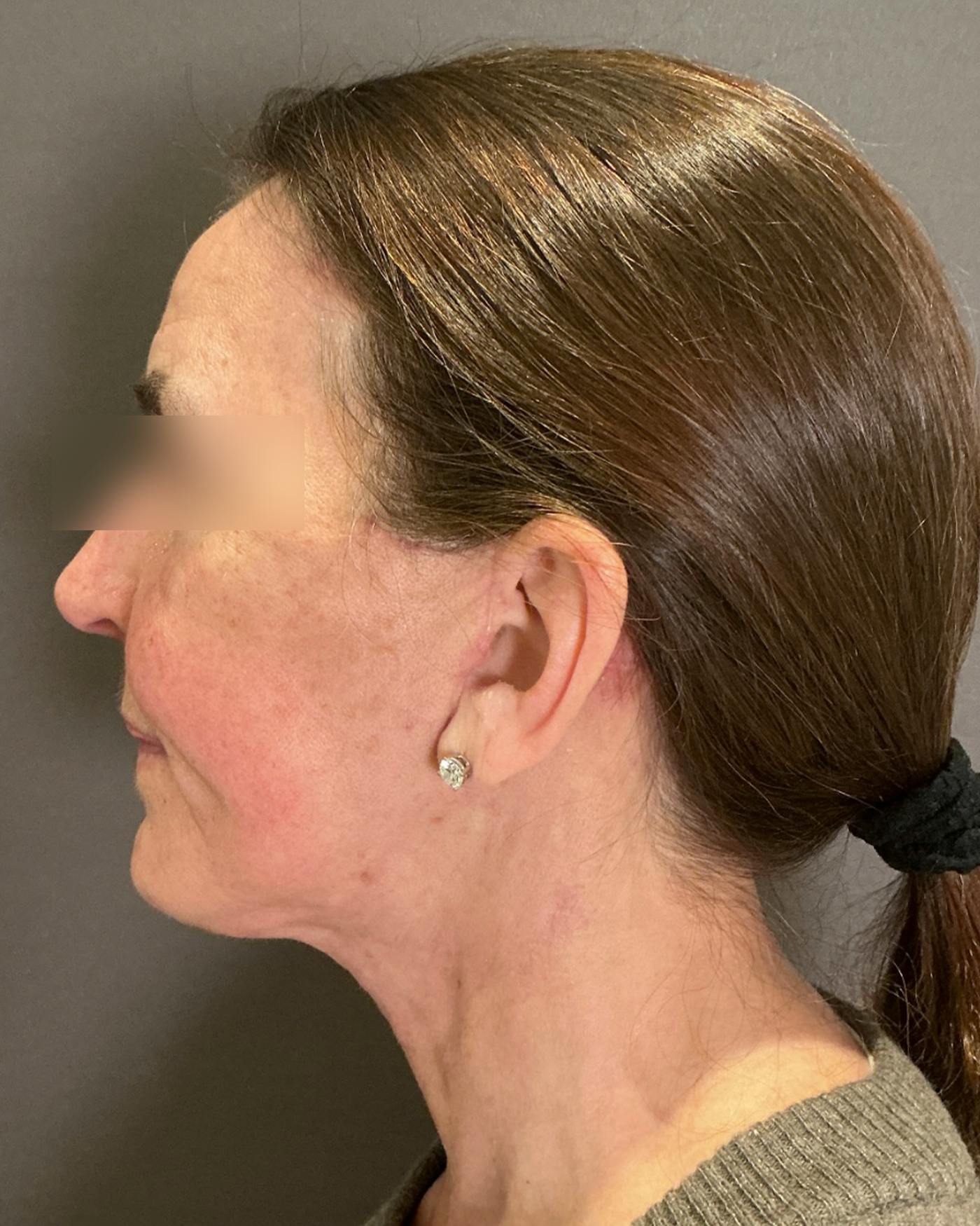 Brow Lift Before & After Gallery - Patient 120517 - Image 8