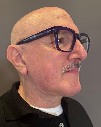 Facelifts / Necklift Before & After Gallery - Patient 210558 - Image 2