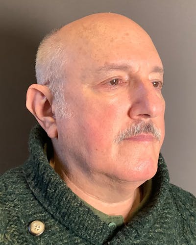 Facelifts / Necklift Before & After Gallery - Patient 210558 - Image 1