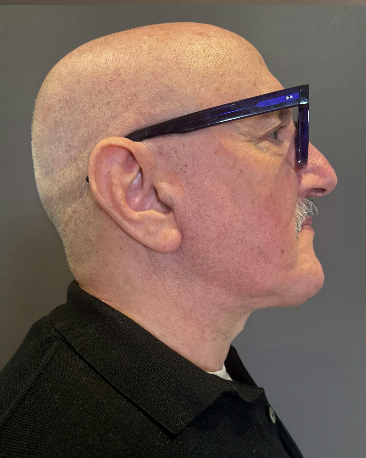 Facelifts / Necklift Before & After Gallery - Patient 210558 - Image 4