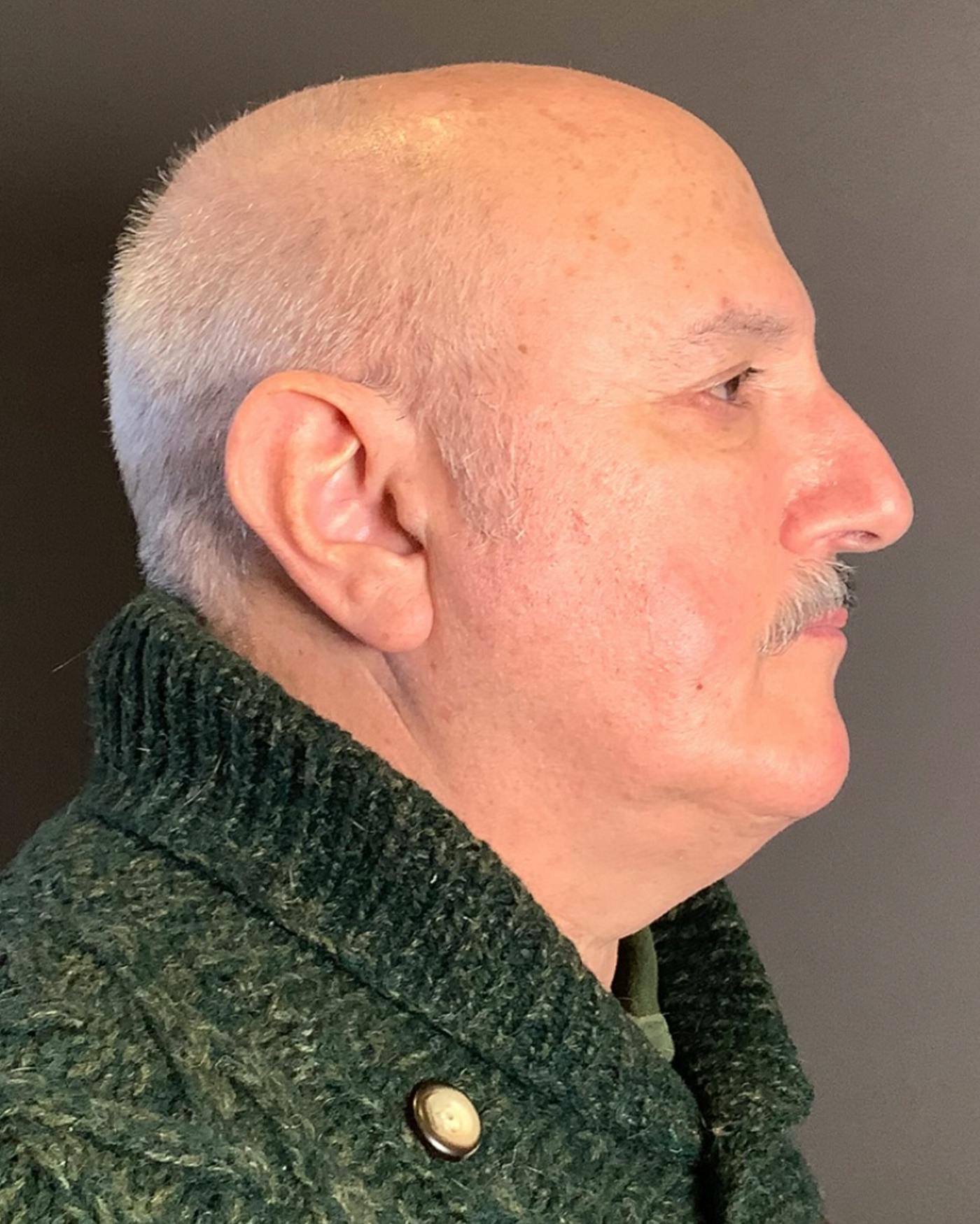 Facelifts / Necklift Before & After Gallery - Patient 210558 - Image 3