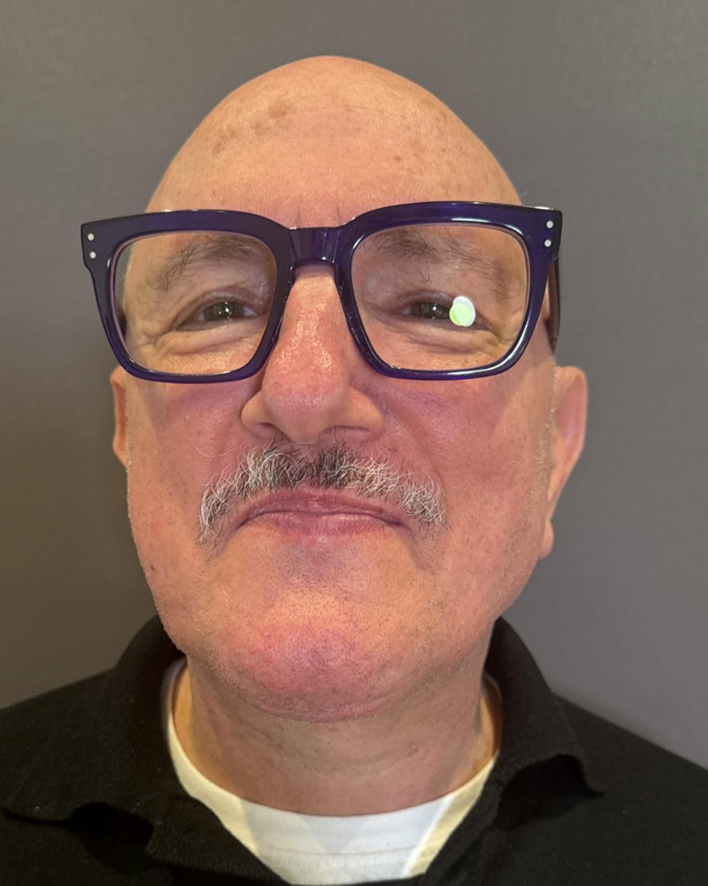 Facelifts / Necklift Before & After Gallery - Patient 210558 - Image 6