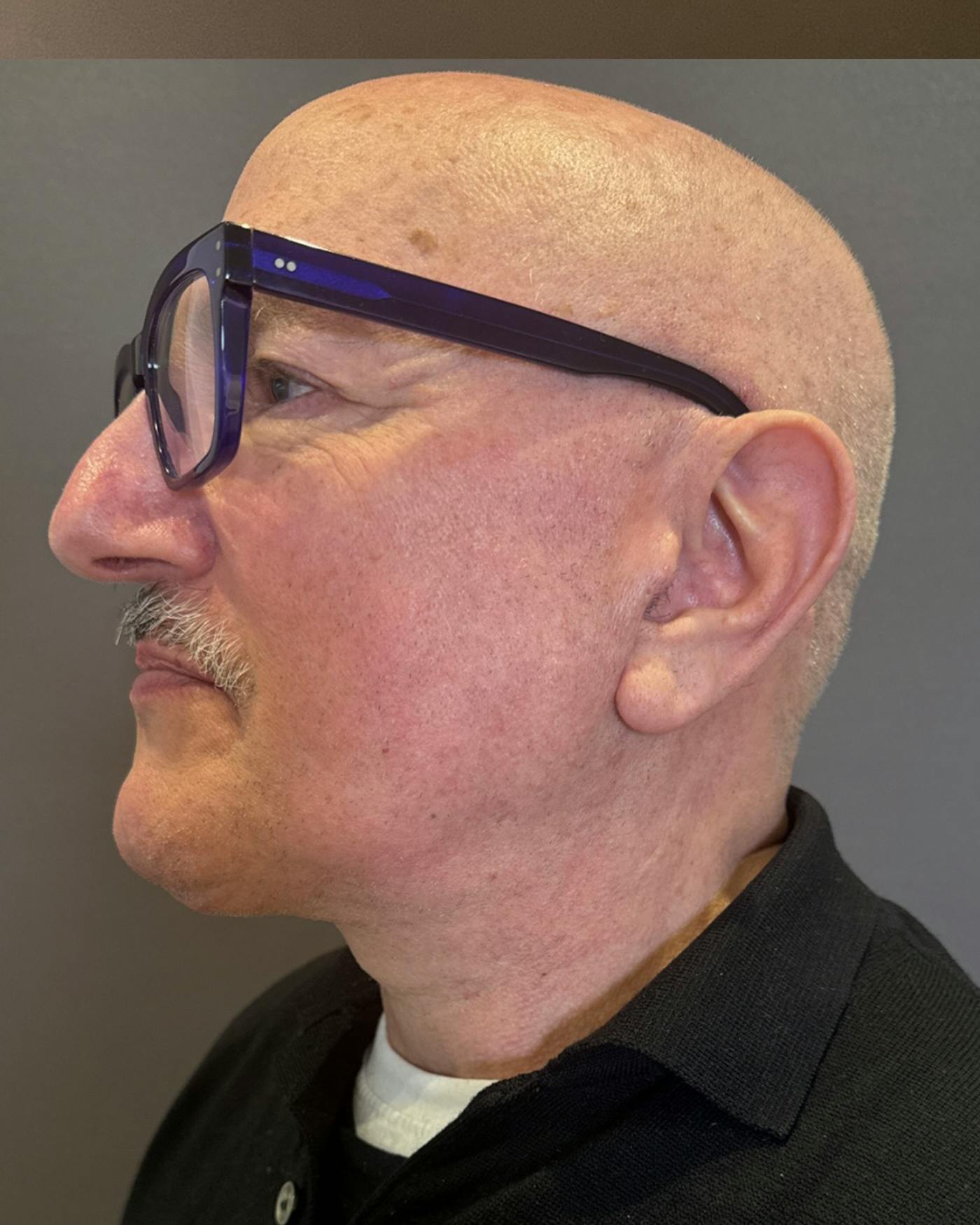 Facelifts / Necklift Before & After Gallery - Patient 210558 - Image 8
