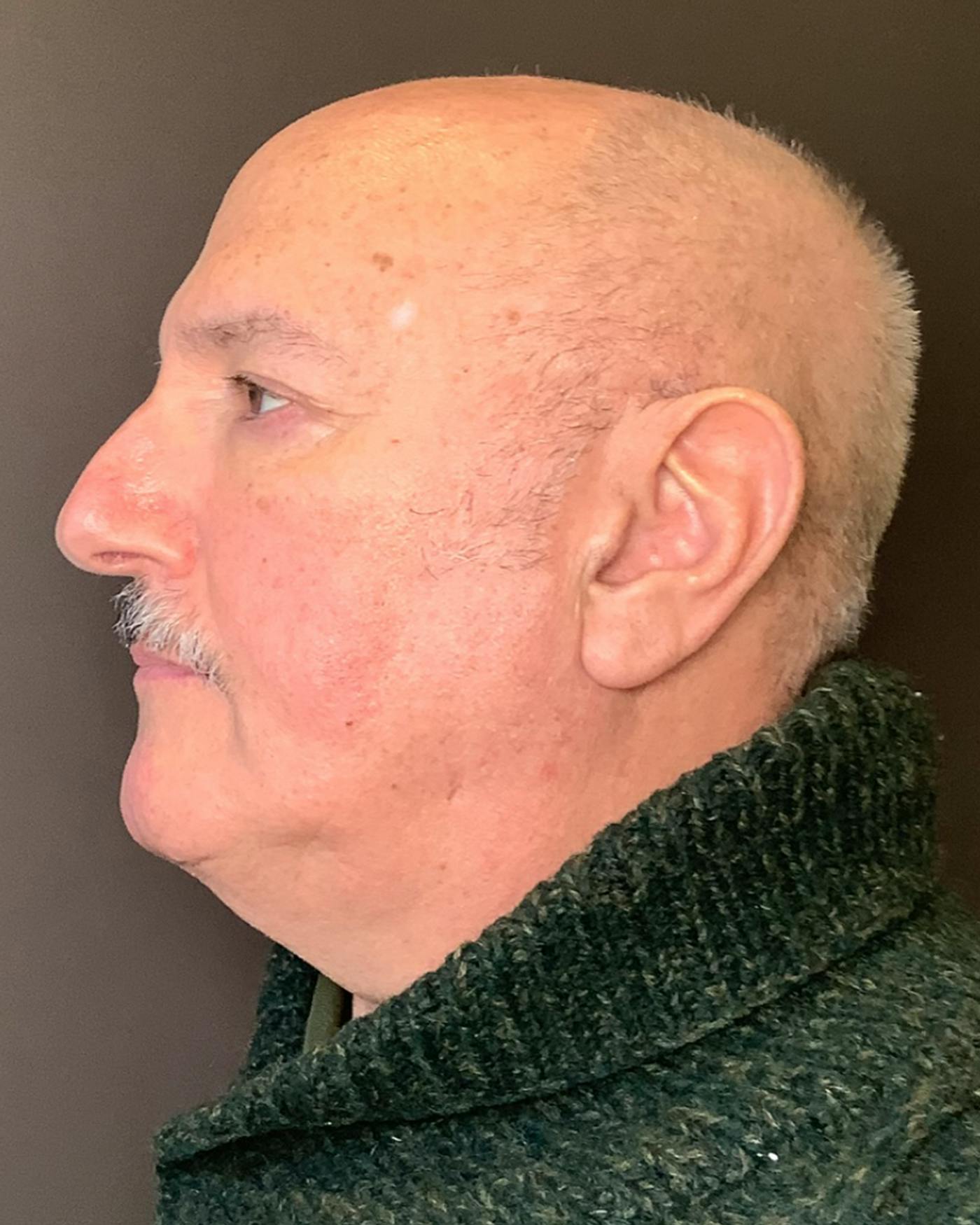 Facelifts / Necklift Before & After Gallery - Patient 210558 - Image 7