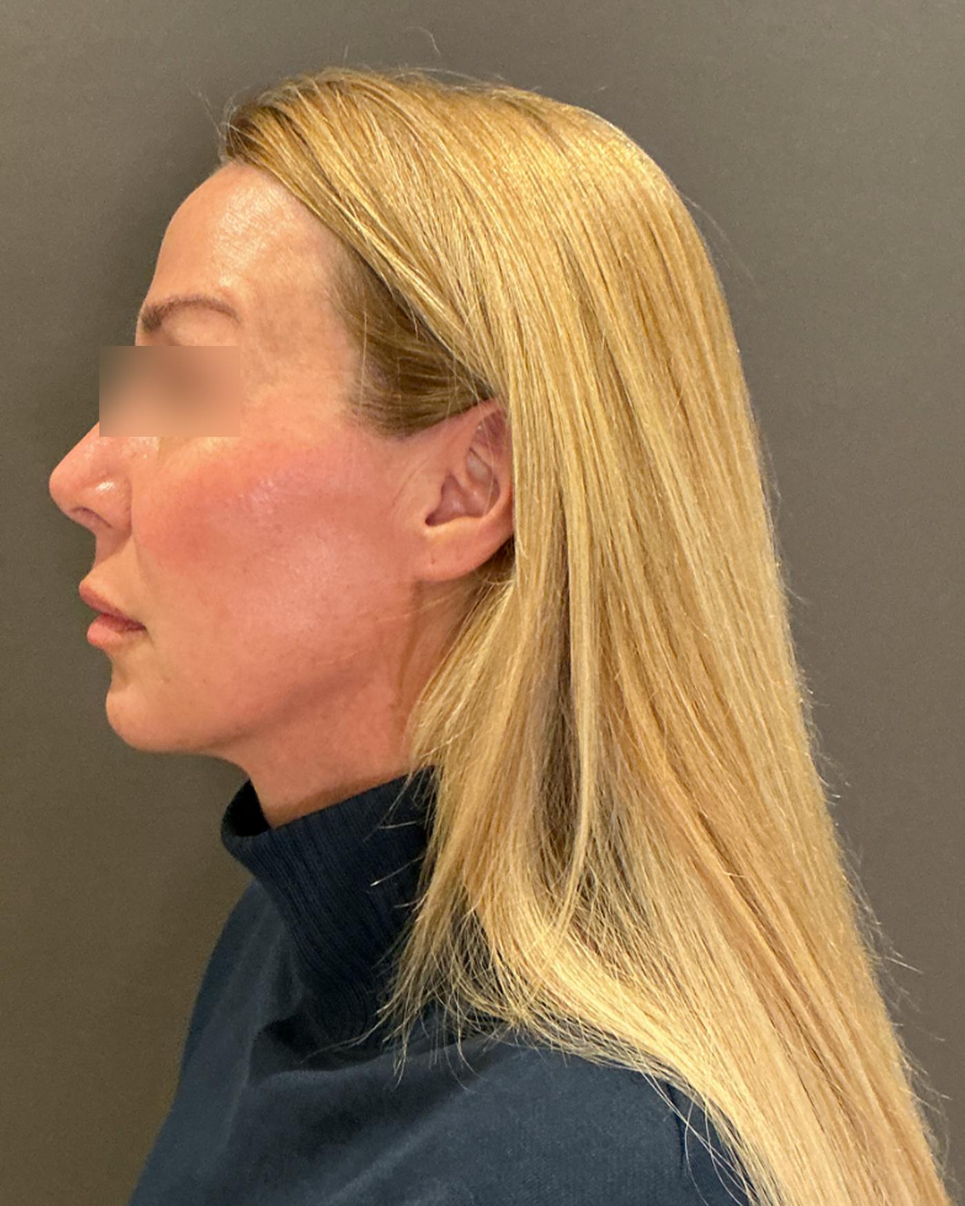 Nanolift Before & After Gallery - Patient 356887 - Image 7