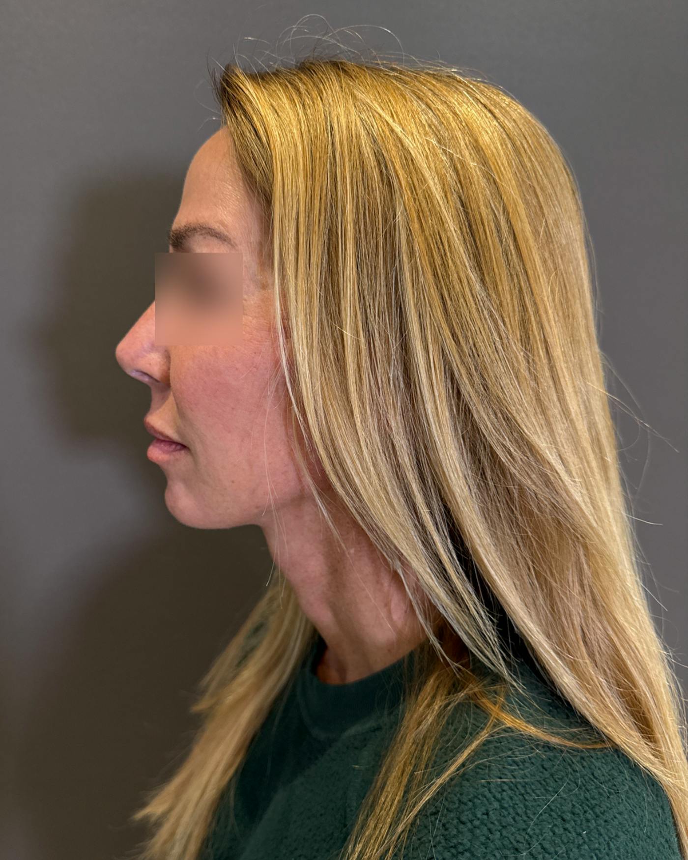 Nanolift Before & After Gallery - Patient 356887 - Image 8