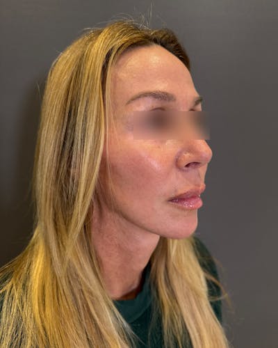 Nanolift Before & After Gallery - Patient 356887 - Image 2