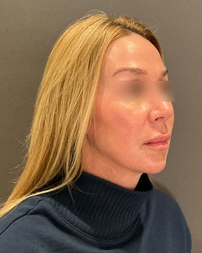 Nanolift Before & After Gallery - Patient 356887 - Image 1