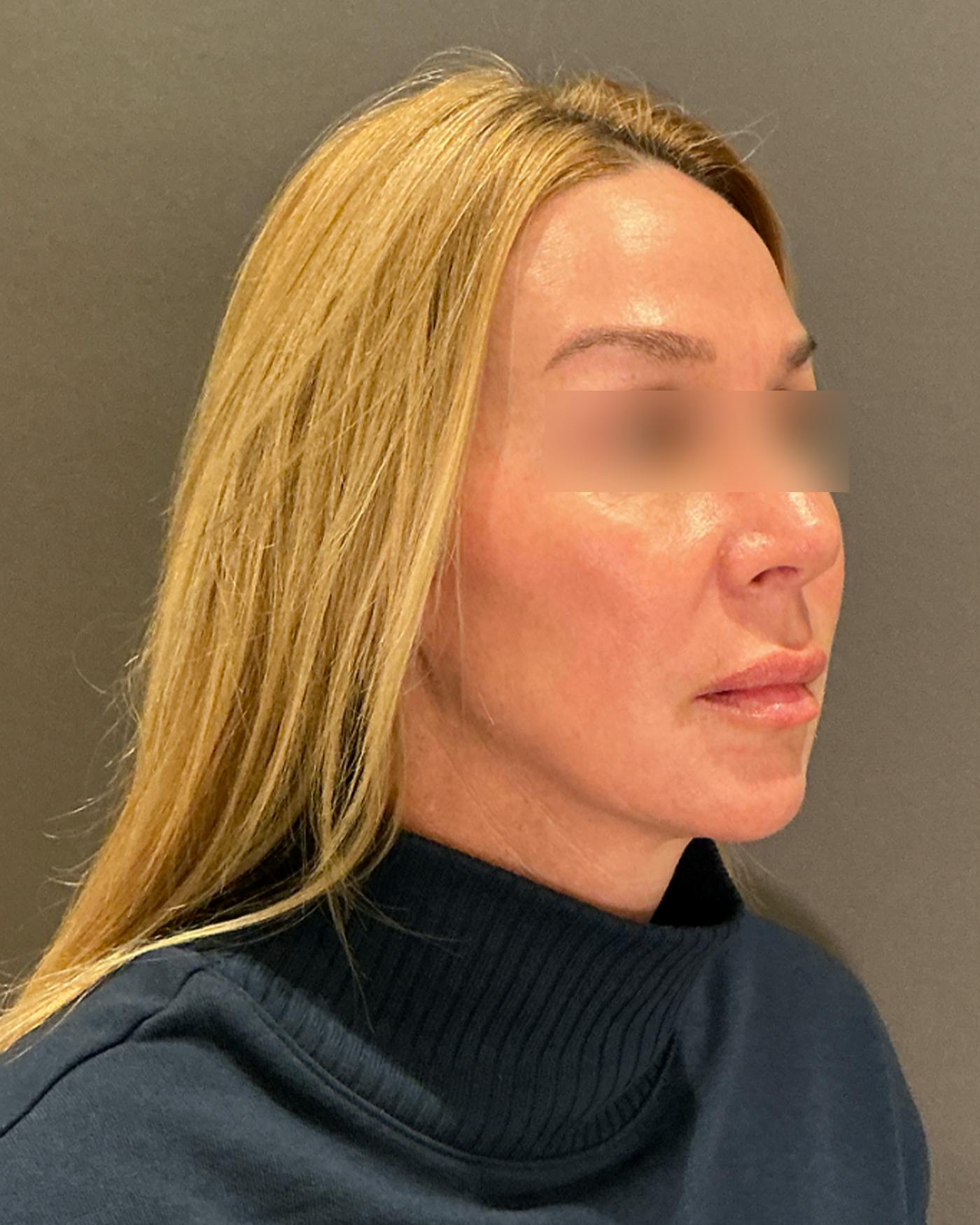 Nanolift Before & After Gallery - Patient 356887 - Image 1