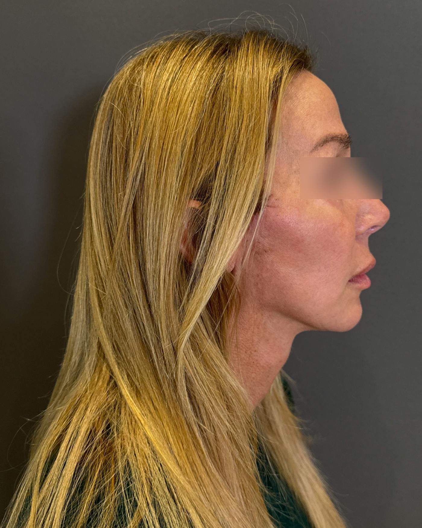 Nanolift Before & After Gallery - Patient 356887 - Image 4
