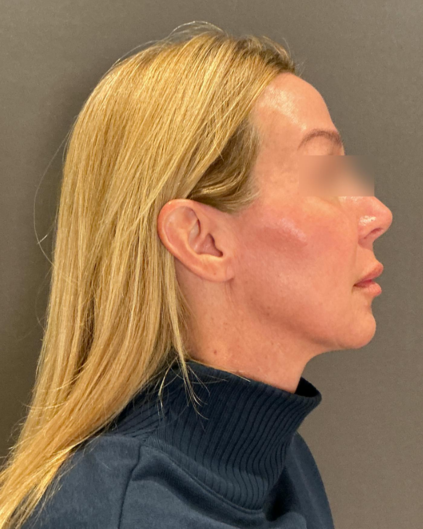 Nanolift Before & After Gallery - Patient 356887 - Image 3