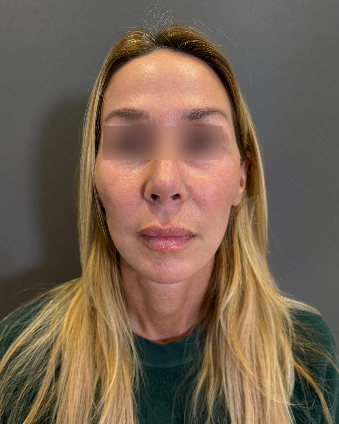 Nanolift Before & After Gallery - Patient 356887 - Image 6