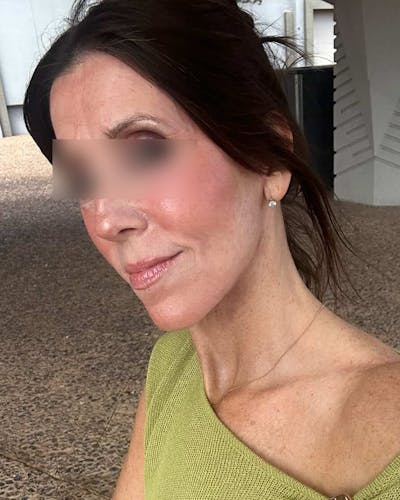 Facelifts / Necklift Before & After Gallery - Patient 836644 - Image 2