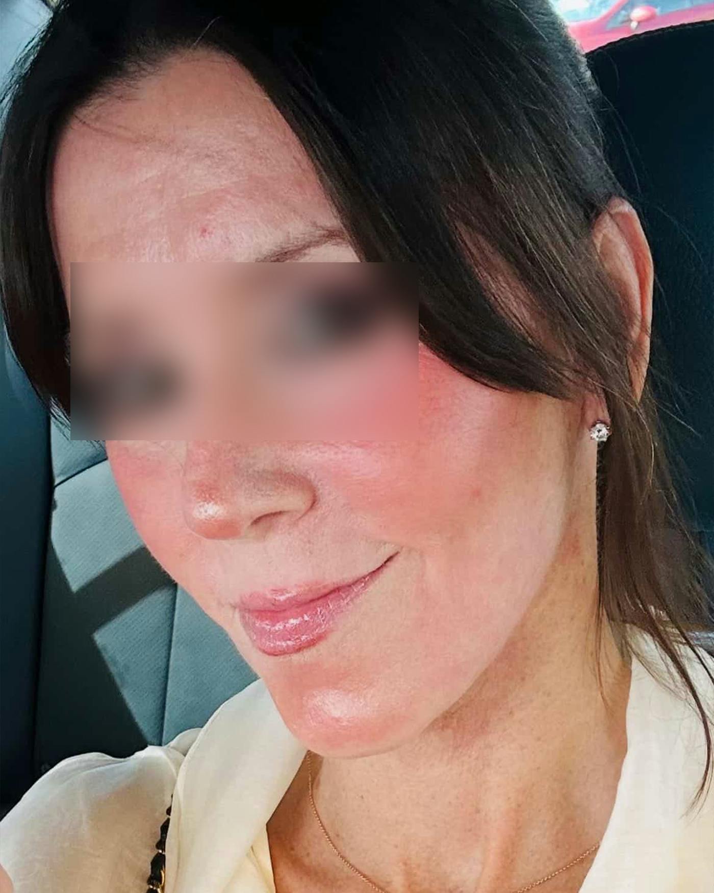 Facelifts / Necklift Before & After Gallery - Patient 836644 - Image 4